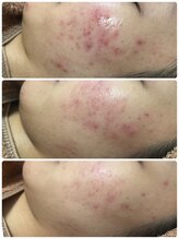 リノ(Lino)/プラズマニア