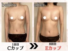 プリマ(prima)/バストアップ症例