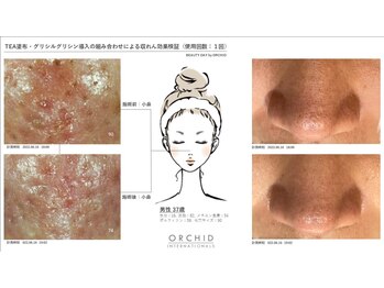 ビューティーデイ バイ オーキッド(BEAUTY DAY by ORCHID)/メンズも◎毛穴ケア徹底コース