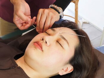 鍼日和の写真/《ルート鬼美容鍼80分¥11000～》ニキビケア/ハリツヤ/たるみ予防/肌質etc...お肌の悩みを鬼美容鍼で改善♪