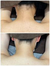 エアリアル 大川店/襟足脱毛