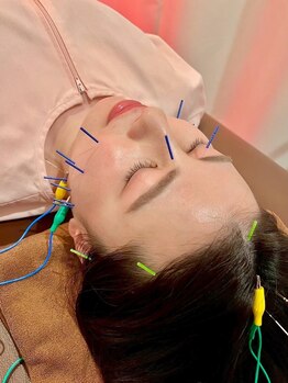 マザーズビューティ鍼灸院整体院 松戸/電気を流して行う美容鍼☆