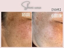 美シェリ(美Cheri)/シミケア＆ララピール