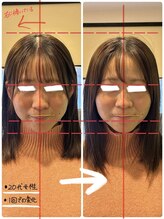 はあと/小顔調整