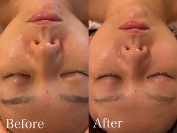 アティレ オオサカ(Attirer Osaka)/毛穴ケア黒ずみくすみハリツヤ