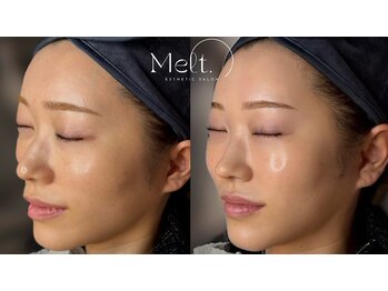 メルト 中目黒(Melt.)/*ララピール