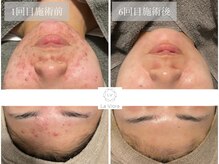 ラヴィオーラ 天王寺(La Viora)/ダイヤモンドハーブピーリング