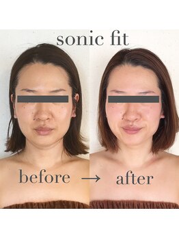 エヌ アンド エイチ ソニックフィット(N&H sonicfit)/法令線・しわ・リフトアップに！