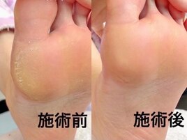 【角質ケア】￥4400→￥2980