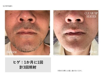 フェレザ 新潟(Felleza)/セルフ脱毛でコスパ最強!