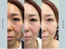 エクソリフトでお肌のお悩み解消！幹細胞導入でリフトup叶います