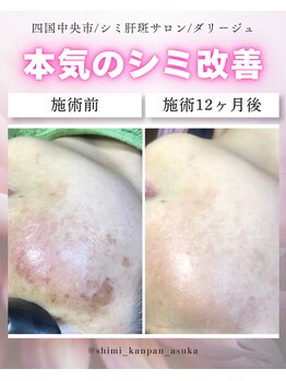 ダリージュ(Daliege)の写真/【紫外線ダメージやシミ・そばかす予防に】光ケア×高濃度導入でトーンを整え透明感あふれる輝く素肌へ♪