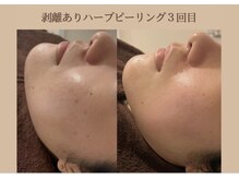 アイル 玉造店(iru)/ハーブピーリング3回目