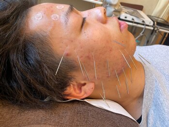 たかさき整骨院の写真/【全身鍼灸・美容鍼で細胞から活性化！】身体の不調の改善に対してさまざまな効果があります☆