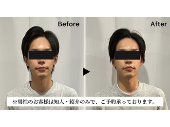 レミュー(Les mieux)/キュッと引き締まったお顔へ