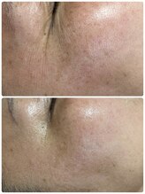 リノ(Lino)/目元のこじわケアも得意