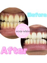 エクシアホワイトニング 新白河店/ホワイトニングビフォーアフター