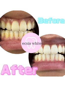 エクシアホワイトニング 新白河店/ホワイトニングビフォーアフター
