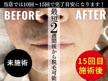 ジェントルメンズグロー(Gentlemen’s Glow)/【ヒゲ脱毛】