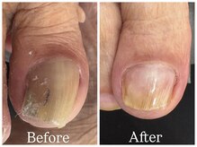 エクランプラス(Ecran+)/巻き爪ケア