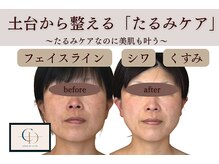 サロンドコーデ(salon de co-de)の雰囲気（リフトマシンで、土台から引き締める本格リフトアップ）