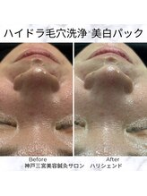 ハリシェンド/ハイドラ毛穴洗浄×美白パック