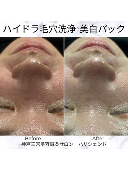 ハリシェンド/ハイドラ毛穴洗浄×美白パック