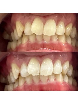 ハリス(HARIS)/セルフホワイトニング