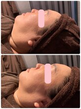 アネル 美里店(anel)/フェイスラインをスッキリ！