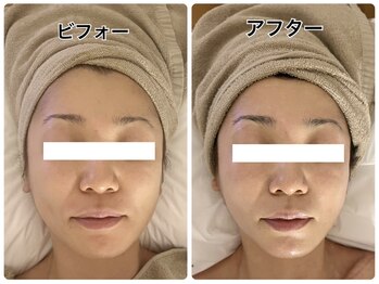 アンジェーム(angeame)/リフトアップもおまかせください