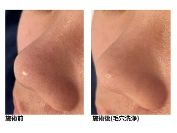 オーシャンブルー 長崎店(OCEAN BLUE)/毛穴の黒ずみケア(毛穴洗浄)