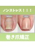【巻き爪矯正】器具不使用でノンストレス★痛みから解放されたい方必見！