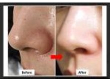 ブプラ イオンマリンピア千葉稲毛海岸店(BUPURA)/ビフォーアフター