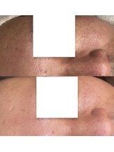 ベリスユイット(BELLIS HUIT)/【剥離なしハーブピーリング】