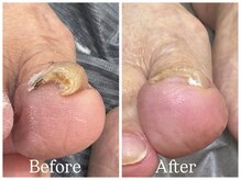 エクランプラス(Ecran+)/巻き爪ケア