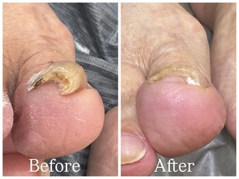 エクランプラス(Ecran+)/巻き爪ケア