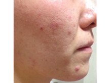 スキンケアスタジオ アコ 新宿店(Aco)/GP肌活２Dのお客様