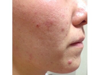 スキンケアスタジオ アコ 新宿店(Aco)/GP肌活２Dのお客様