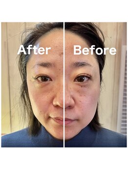 プルベル 宇都宮店(Plus Belle)/小顔矯正/たるみ改善/しわ改善