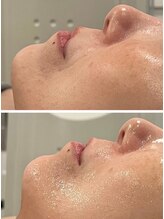 レヴール 京都四条烏丸店(Reveur)/ハーブピーリングでトーアップ