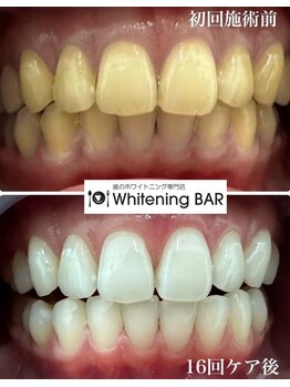 ホワイトニングバー 福島店/16回照射終了ビフォーアフター