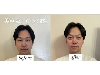 ヤマモト 表参道院(YAMAMOTO)/美容鍼　筋膜調整