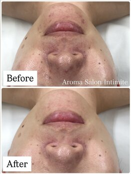 アンティミテ(Intimite)/パーソナルスキンケアコース