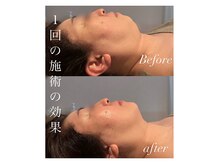 ベルシア(BELXIA)/ハーブピーリングで輪郭も変化