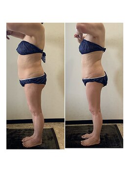 ヴィオテラス(VIOTERACE)/☆★キャビ＋ラジオ波＋EMS