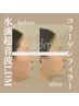 【モニター限定】韓国発コラーゲンフィラー“ULDM” ¥11,000～上限あり(回数)