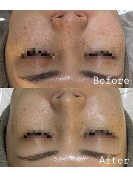 アテ(Ate)/美白の結果出し◎