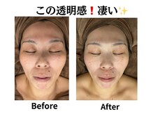 グレースティー 森町 箕面/シミ・くすみ★薄く改善！！