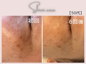 美シェリ(美Cheri)/シミケアビフォーアフター