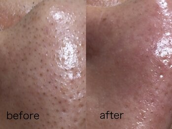 サロン フィオーレ(salon fiore)の写真/黒ずみ毛穴気になる?美容液を使用する贅沢な毛穴洗浄なら当店へ!丁寧なクレンジング洗浄で満足の素肌♪